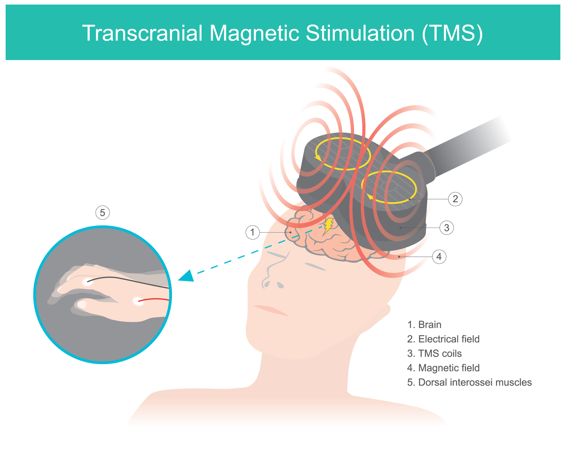 TMS therapy